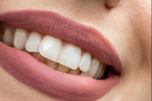 woman with whitened smile